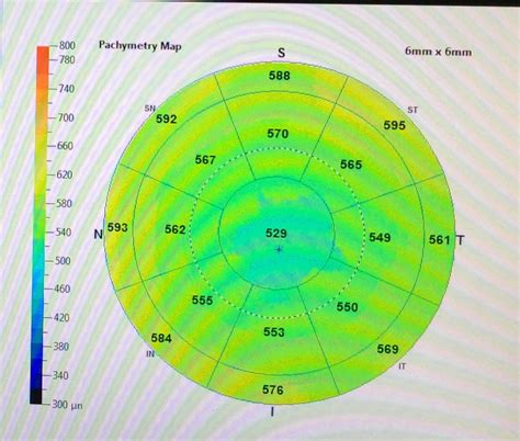 how to measure corneal thickness